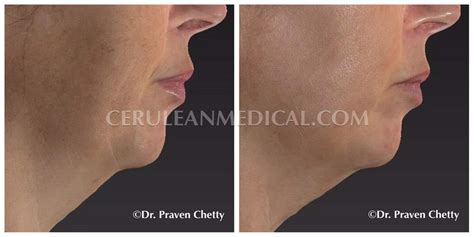 IPL-before-and-After-Photo-1 - Cerulean Medical Institute - Kelowna BC