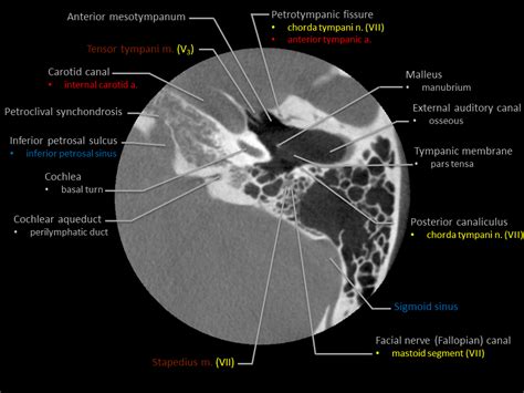 Chorda Tympani Petrotympanic Fissure