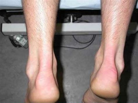 Insertional tendinopathy of tendoachilles