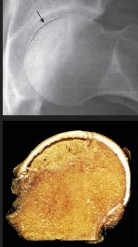 Fichas De Aprendizaje Osteonecrosis Enfermedad De Paget Y Displasia