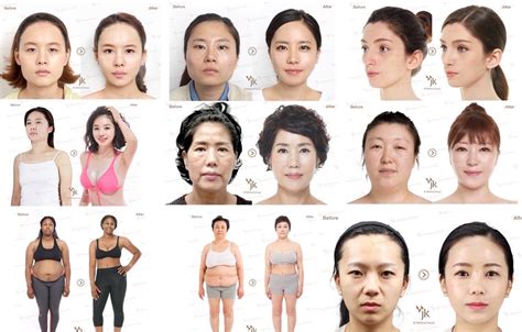 Plastic surgery in South Korea (prices, clinics, reviews, procedures ...