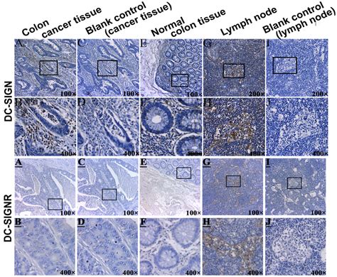 Ihc For Dc Sign And Dc Signr Expression In Colon Cancer Tissues And In Download Scientific