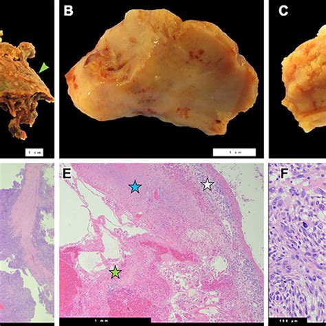 A C Gross And D F Microscopic Images Of The Resected Tumor A