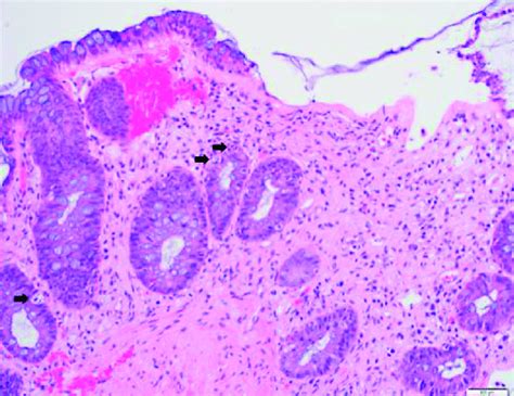 Colonic Tissue With Features Of Graft Versus Host Disease Histologic Download Scientific