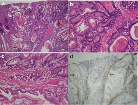 Pathological findings. Foveolar hyperplasia on polyp surface (a ...