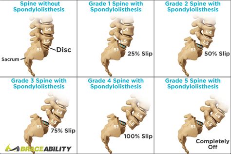 Spondylolisthesis Types