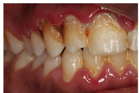 Ultimate Guide To Acute Necrotising Ulcerative Gingivitis Anug