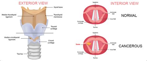 Larynx Cancer Life Expectancy