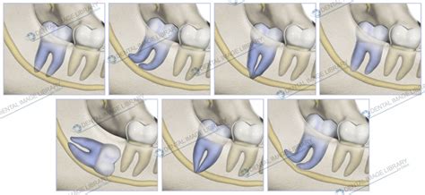 Classification Of The Third Molar In Relation To Inferior Alveolar