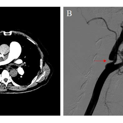 Imaging Data A Pulmonary Computed Tomography Angiography