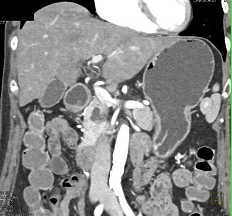 Ctisus Everything You Need To Know About Computed Tomography Ct