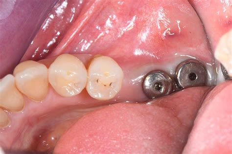 Implants Cas 7 Ebdental