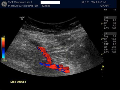 Lower Extremity Bypass Baton Rouge | Peripheral Vascular Bypass