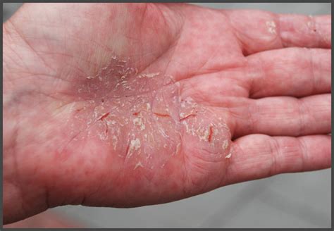 Psoriasis on hands pictures | Psoriasis expert