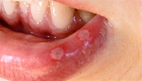 Aphthous Stomatitis Treatment