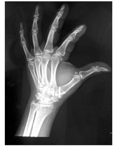 Arthrodesis postoperation | Download Scientific Diagram