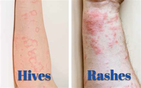 Rash Vs Hives How To Identify And Treat Them Naturally