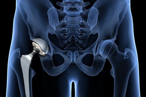 What You Need To Know About Hip Replacements Mid Atlantic Orthopedic