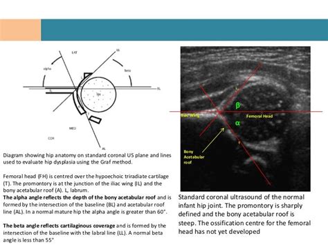 Anatomy - Hip Joint - Congenital hip dislocation ultrasound angles ...