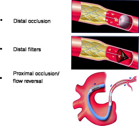 Devices For Distal Protection During Percutaneous Coronary