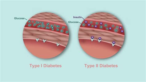 Is Diabetes Hereditary How Your Genes Can Play A Role Everyday Health