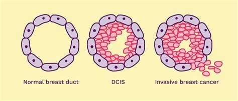 Ductal Carcinoma In Situ Dcis Breast Cancer Now