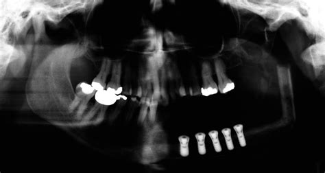 Long Term Results Of Jaw Reconstruction With Microsurgical Fibula