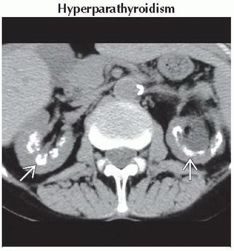 Da15 Db1 Medullarynephrocalcinosis Ffu1 Abdominal Key