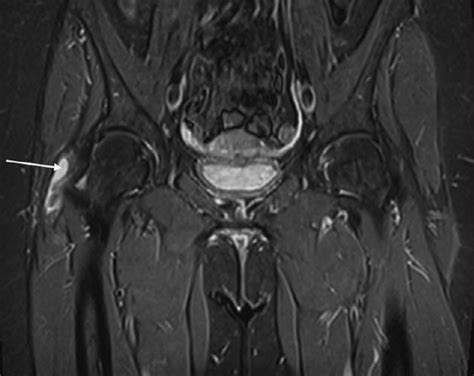 Gluteus Medius Tendinitis Symptomen En Natuurlijke Behandelingen