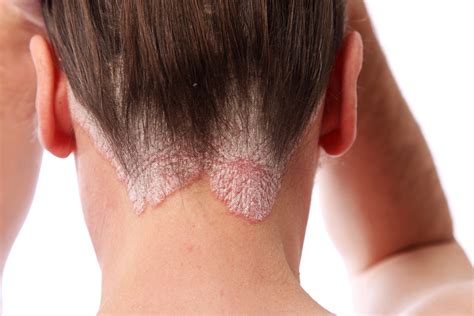 What Does Scalp Psoriasis Look Like Prosoria Psoriasis Treatment