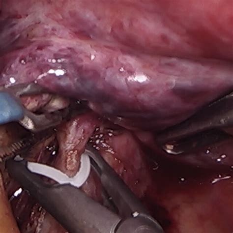 Securing A Spigelian Vessel During Laparoscopic Caudatectomy