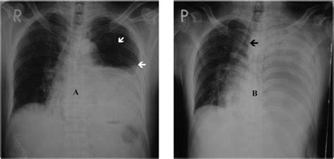 Two Consecutive Chest Radiographs With Tension Hydropneumothorax A