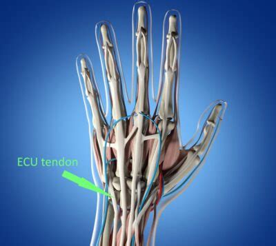 ECU Tendonitis: The Common Wrist Injury Explained - Sport Doctor London