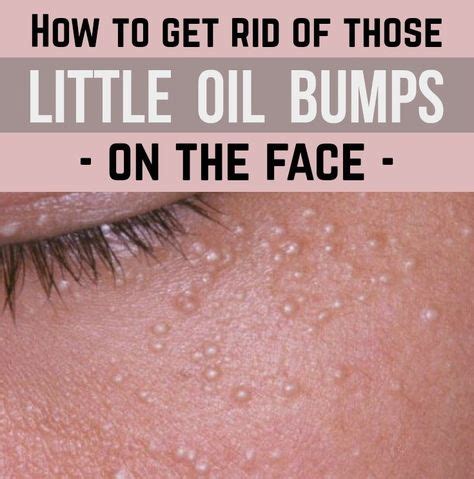 8 White bumps on face ideas | white bumps on face, skin care, forehead ...