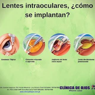 Clínica de Ojos Oftalmic Láser Lentes intraoculares cómo se implantan