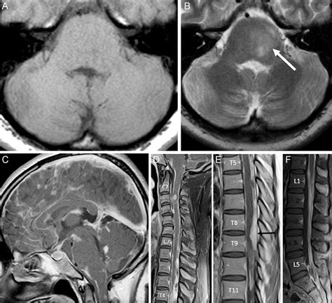 Axial T1 A And T2 Weighted Images B Postcontrast Sagittal