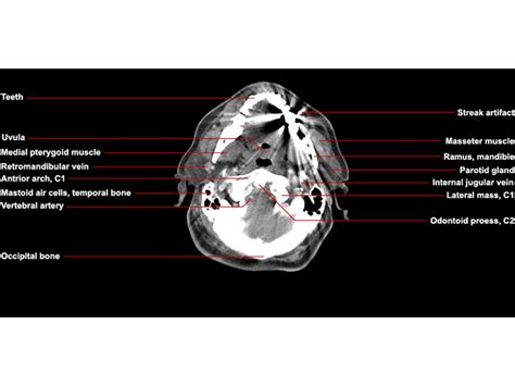 Ct Neck Axial Anatomy Radiologypics Com