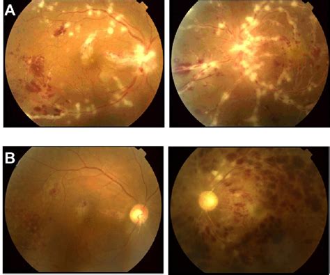 Figure From Bilateral Acute Retinal Necrosis After Herpetic