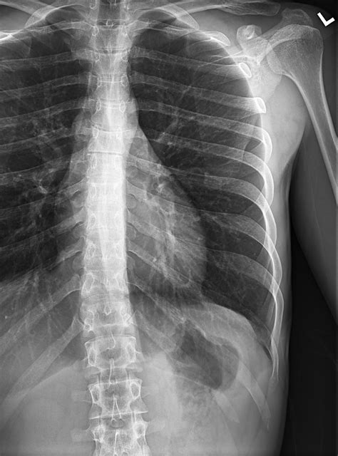 Chest and Ribs xray ; left lower rib dark spot while no dark spot in