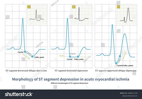 St Segment Depression