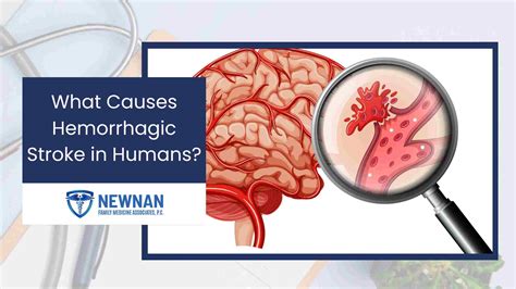 What Causes Hemorrhagic Stroke in Humans?