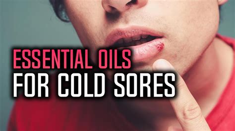 Best Essential Oils For Cold Sores Youtube