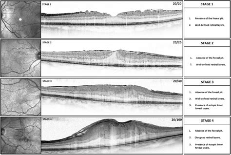 Insights Into Epiretinal Membranes Presence Of Ectopic Inner Foveal Layers And A New Optical