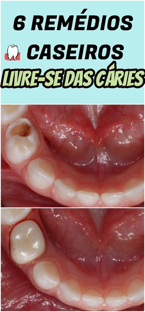 Os 6 Remédios Caseiros Para Curar Cáries Naturalmente Remédios Caseiros