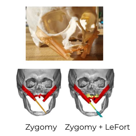 Rozpocznij Leczenie Implantami Zygomatycznymi Polorto