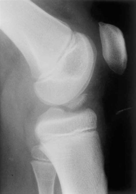 Figure From Avulsion Fracture At The Femoral Attachment Of The