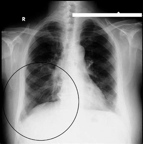 X Ray Chest Erect Showing No Air Under The Diaphragm Download Scientific Diagram