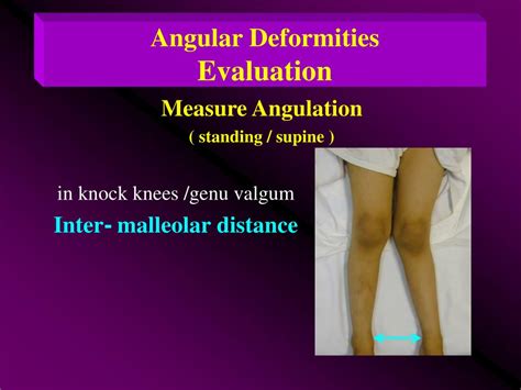 Ppt Angular Deformities Of Ll Bow Legs Knock Knees Rotational Deformities Of Ll In Toeing