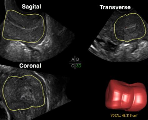 Sonographic Measurement Of Cervical Volume In Pregnant Women At High