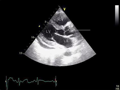 Isolated Pulmonary Valve Endocarditis In A Patient With Aplastic Anaemia Bmj Case Reports